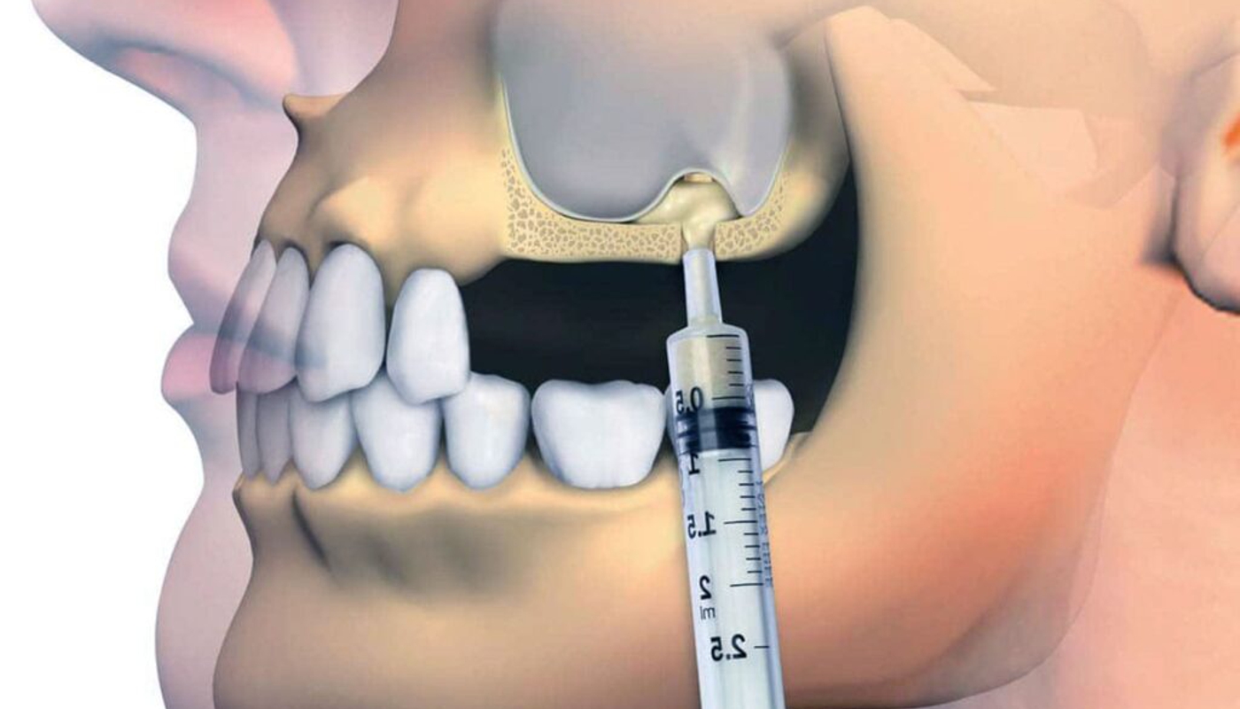 implantologia dentale